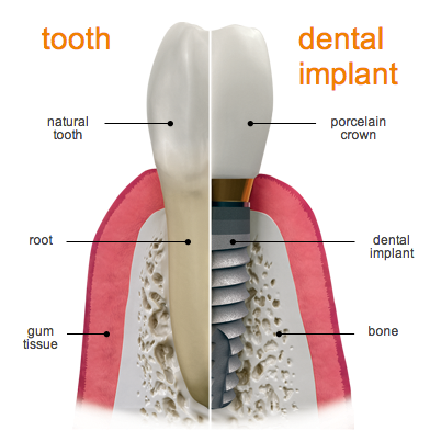 impianti dentali