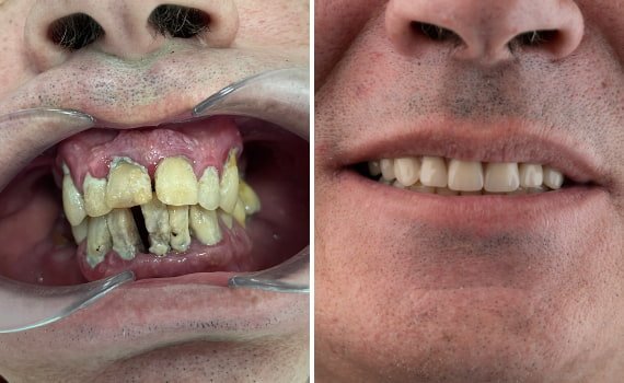 Le faccette in ceramica  nella clinica dentale Grand Turismo Dentale di Chisinau sono le più utilizzate grazie alla resistenza ottimale del materiale, e al fatto non trascurabile che si tratta di restauri adesivi minimamente invasivi.