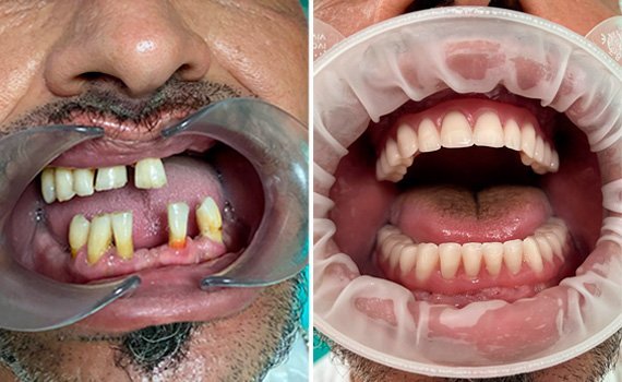 Le faccette in ceramica  nella clinica dentale Grand Turismo Dentale di Chisinau sono le più utilizzate grazie alla resistenza ottimale del materiale, e al fatto non trascurabile che si tratta di restauri adesivi minimamente invasivi.