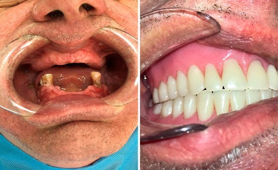 Pulizia dei Denti Professional  ha rimosso anni di scolorimento da tè, caffè e tabacco dai denti di questo paziente nella clinica dentale Grand Turismo Dentale di Chișinău