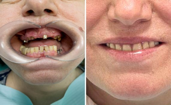 Le faccette in ceramica  nella clinica dentale Grand Turismo Dentale di Chisinau sono le più utilizzate grazie alla resistenza ottimale del materiale, e al fatto non trascurabile che si tratta di restauri adesivi minimamente invasivi.