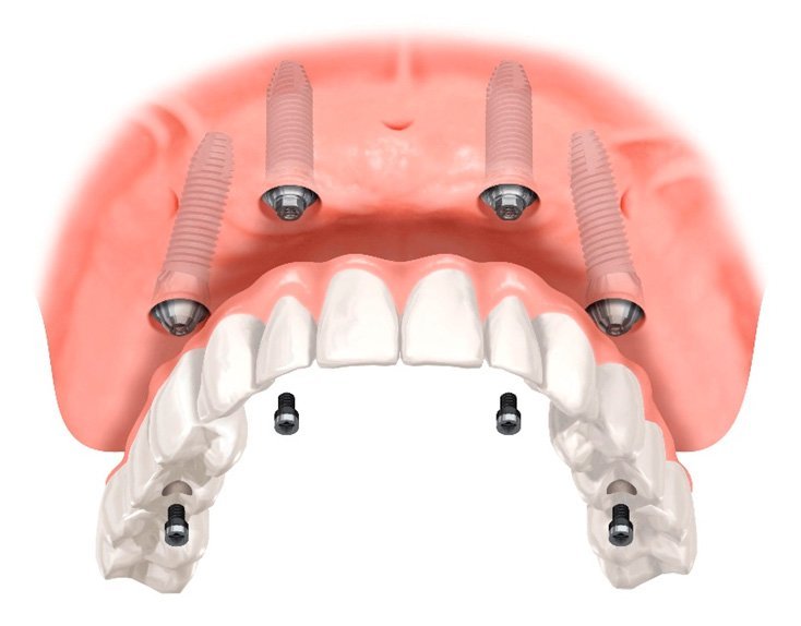 Impianti Dentali